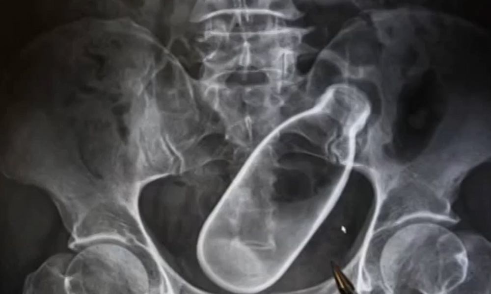 Operat de urgență după ce a stat o săptămână cu o sticlă de suc în anus operat-de-urgenta-sticla-de-suc-in-anus